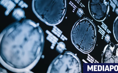 Смятани за революционни лекарства срещу Алцхаймер се оказват силно надценени