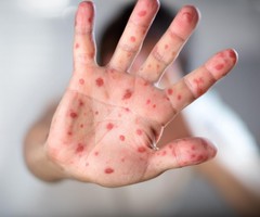 Съобщените случаи на морбили в страната станаха 149