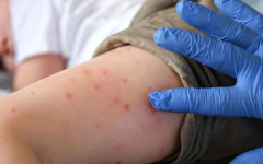 Ръст на заболелите от морбили: 153 са вече случаите у нас