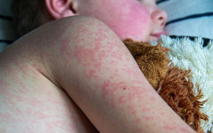 6 нови случая на морбили само във Враца за ден, броят на заболелите достигна достига 159