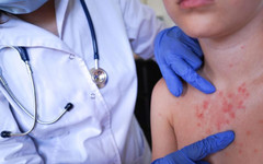 Шест нови случая на морбили са регистрирани в страната