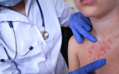 Шест нови случая на морбили са регистрирани в страната